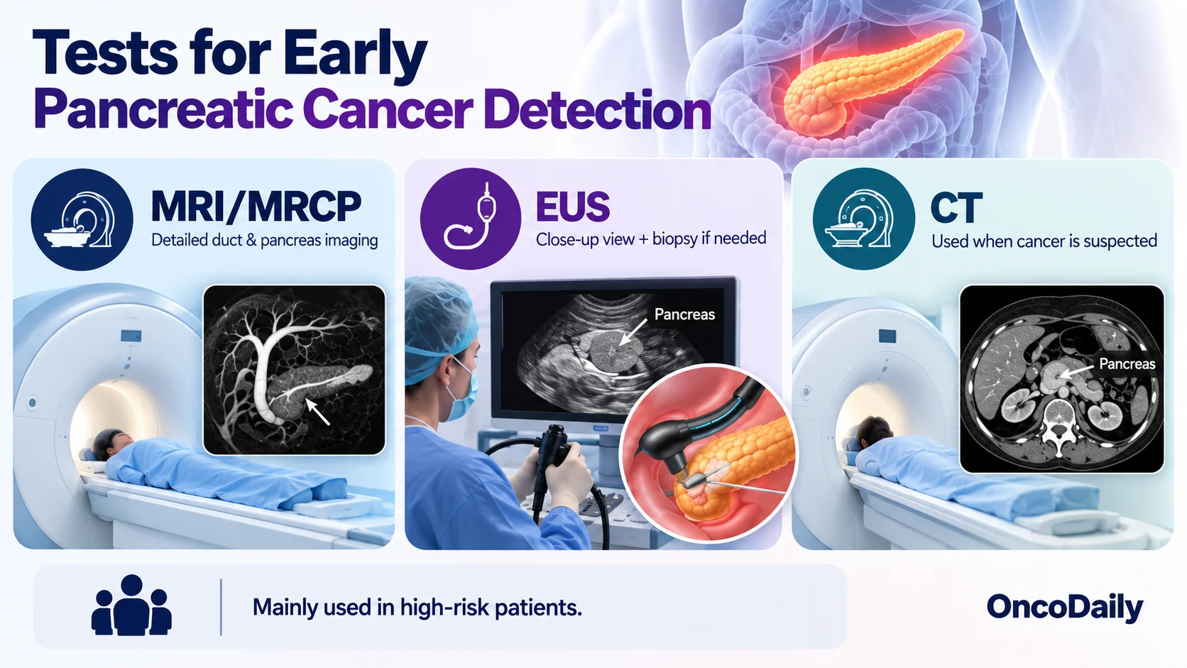 Can Pancreatic Cancer Be Detected Early? Symptoms, Biomarkers, and New Tests