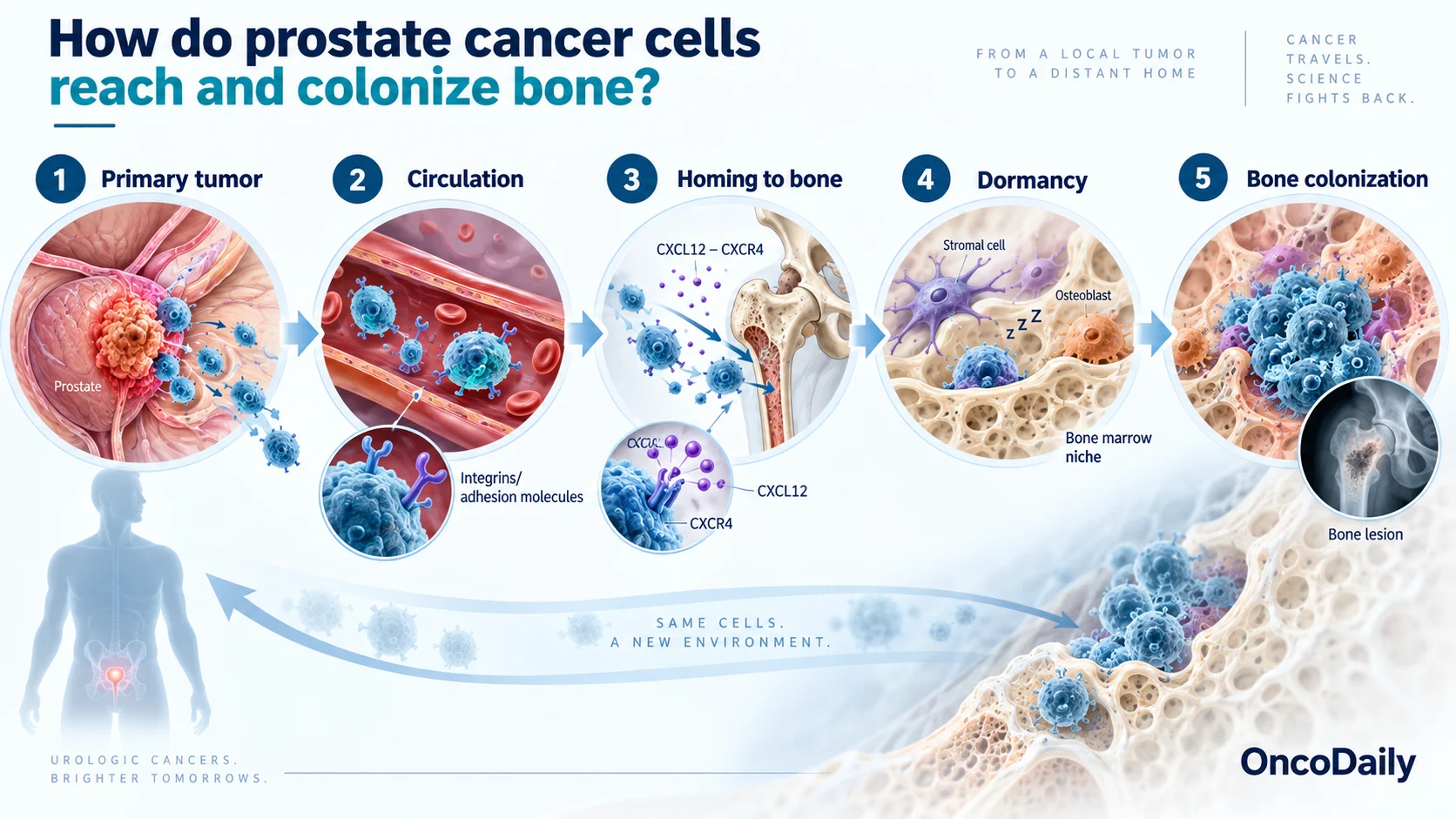 Why Prostate Cancer Spreads to Bone: The Biology Behind Bone Metastases 6 Why Prostate Cancer Spreads to Bone: The Biology Behind Bone Metastases