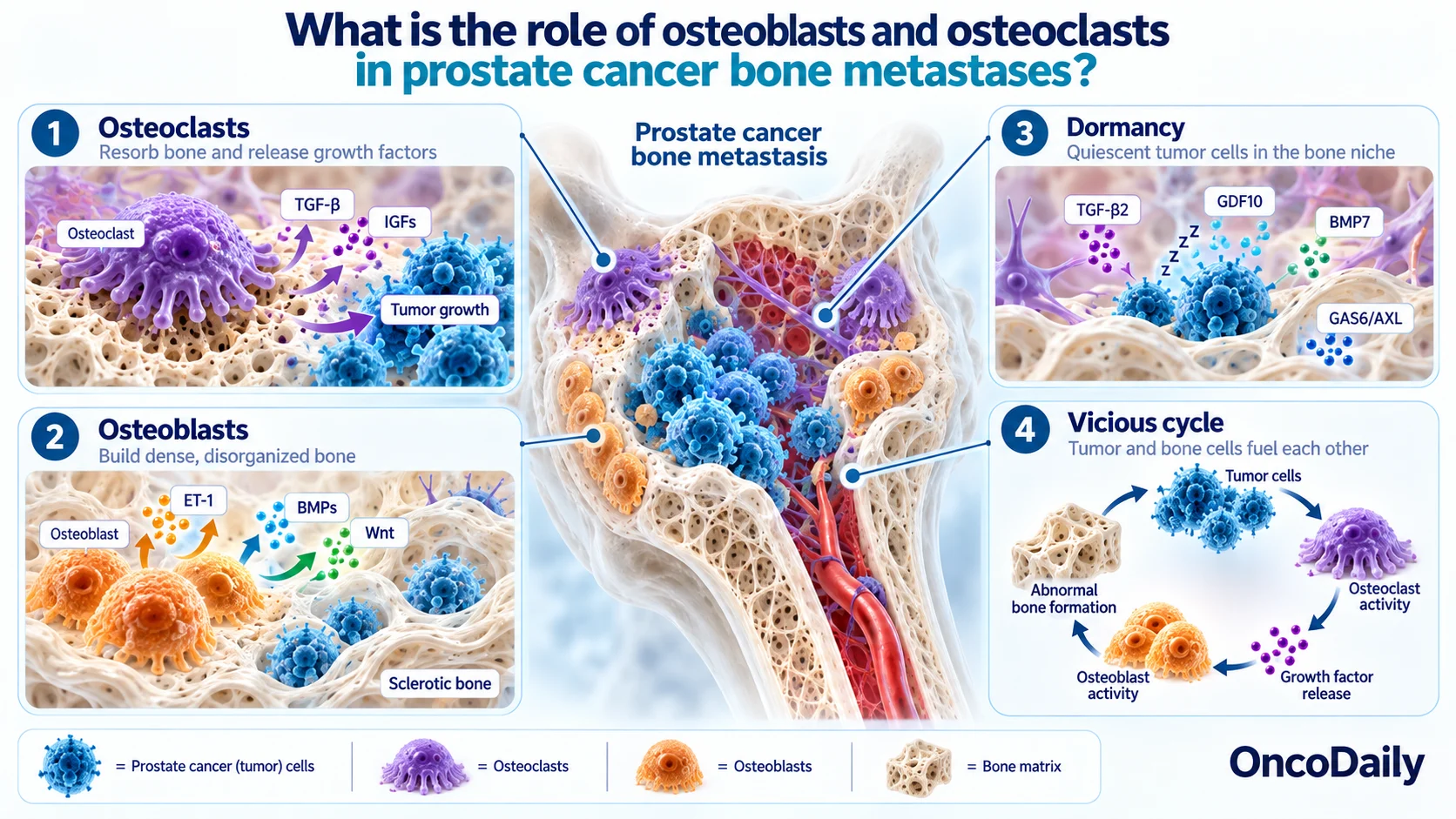 Why Prostate Cancer Spreads to Bone: The Biology Behind Bone Metastases 8 Why Prostate Cancer Spreads to Bone: The Biology Behind Bone Metastases