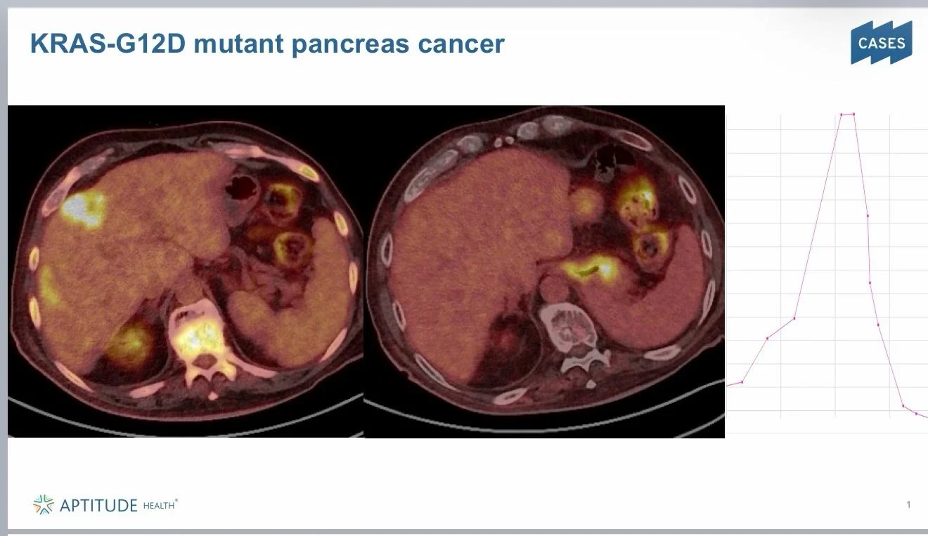 Pashtoon Kasi: The Results and Activity of the New Pancreatic Cancer Pill Are Phenomenal