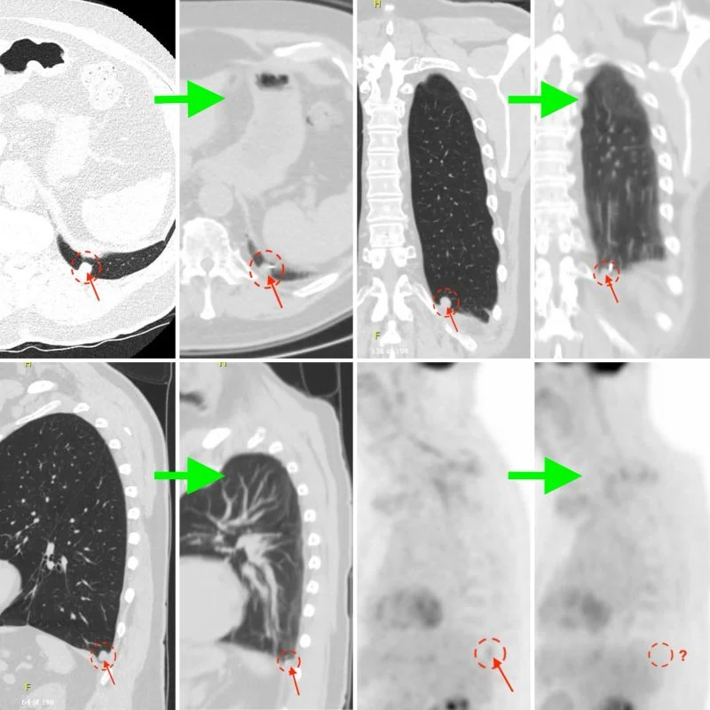 Ali Abedi Highlights Treatment Response to Bronchoscopic Pulsed Electric Field Ablation of a Lung Metastasis 2 Ali Abedi