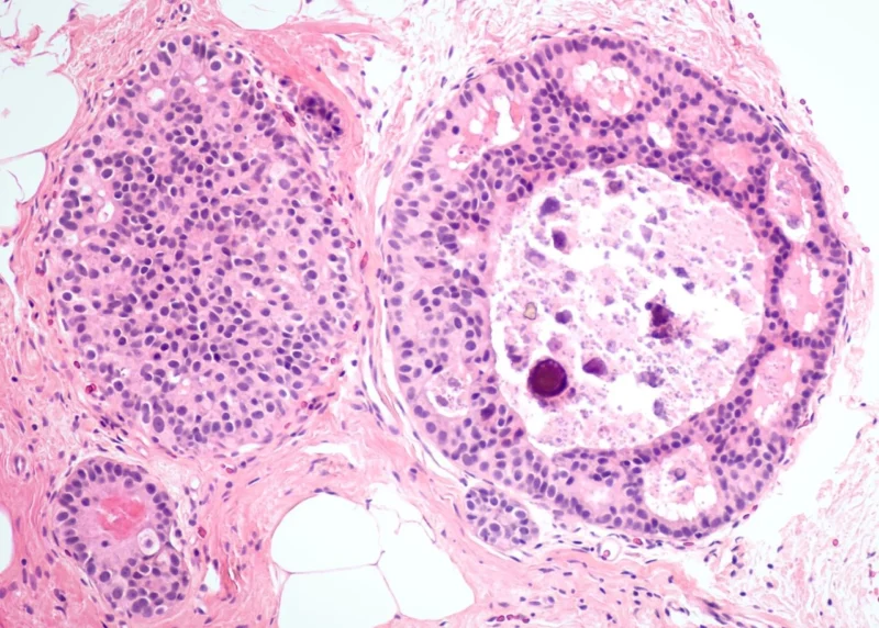 IARC Compared PCR Testing With Immunohistochemistry to Distinguish Breast Cancer Subtypes in LMICs - IARC/WHO 2 IARC/WHO