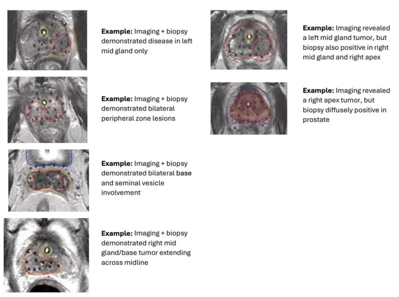 Abhishek A. Solanki: F-SHARP Points to Risk-Adapted Salvage Re-Irradiation in Prostate Cancer 2 Abhishek A. Solanki: F-SHARP Points to Risk-Adapted Salvage Re-Irradiation in Prostate Cancer
