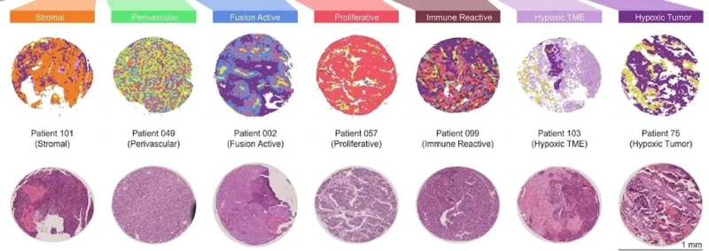 Enrique de Álava: New Study Reveals Four Distinct Tumor Profiles in Ewing Sarcoma 2 Enrique de Álava: New Study Reveals Four Distinct Tumor Profiles in Ewing Sarcoma