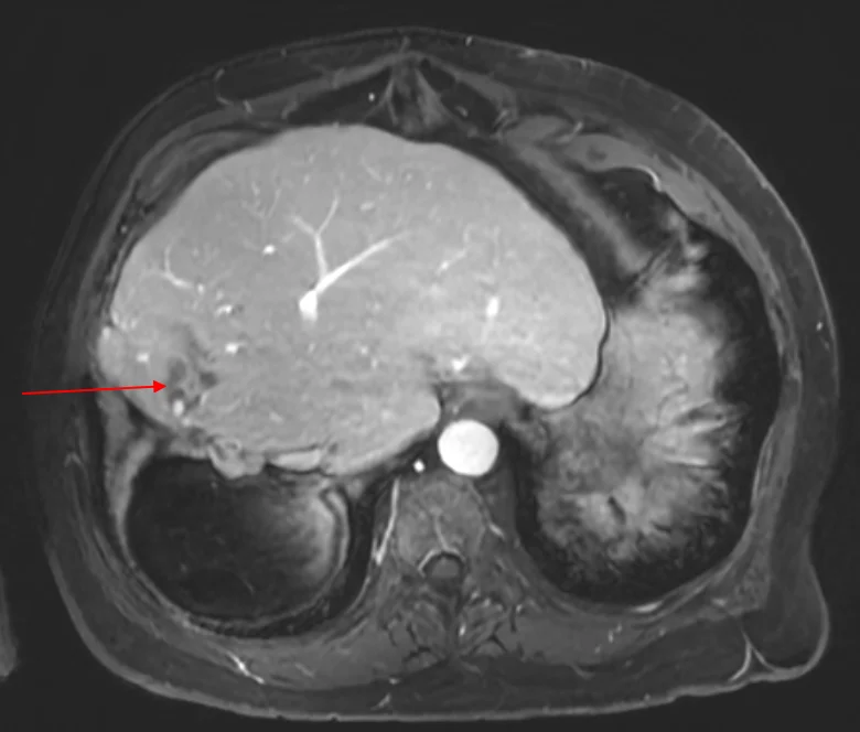 Thor Halfdanarson: Clinical Lessons From MEN1 and Neuroendocrine Tumor Imaging 2 Thor Halfdanarson