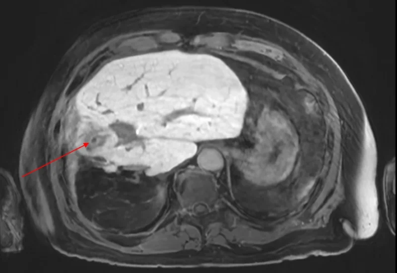 Thor Halfdanarson: Clinical Lessons From MEN1 and Neuroendocrine Tumor Imaging 3 Thor Halfdanarson