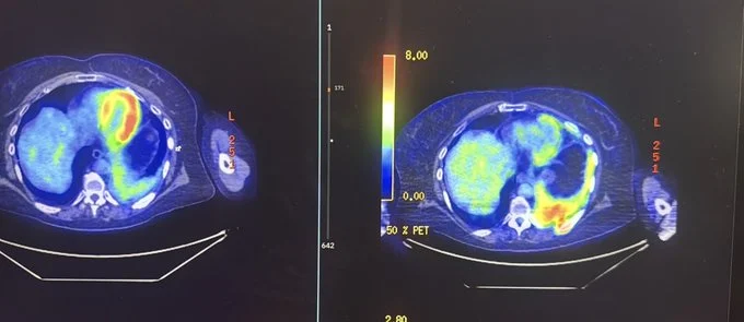 Al-Ola A Abdallah: A Remarkable Outcome in Penta-Refractory Myeloma After Just One Dose of Belantamab