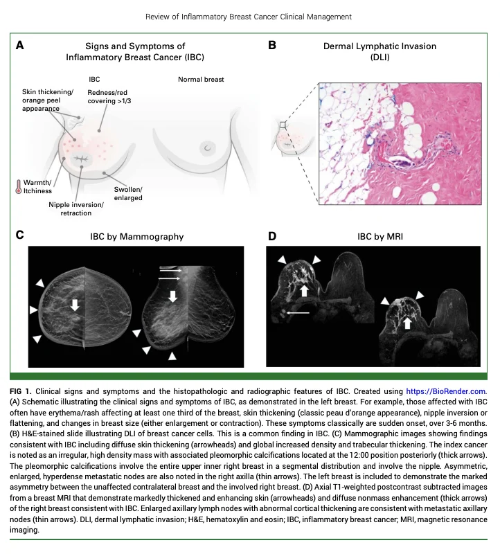 Inflammatory Breast Cancer