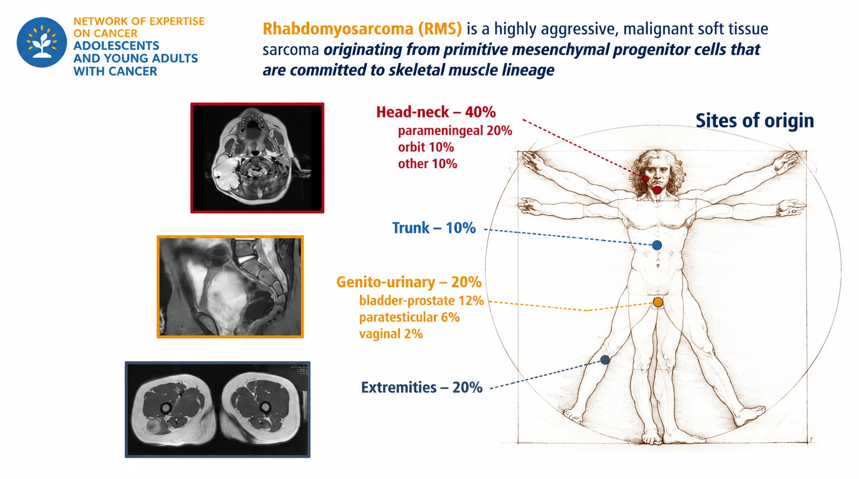 Andrea Ferrari: The Rhabdomyosarcoma Paradox - Better Treatment, Persistent Survival Gaps 2 Andrea Ferrari