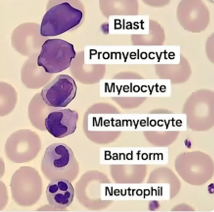 Aaron Goodman: Simplified CD Marker Profiles for Leukemia Classification 2 Aaron Goodman: Simplified CD Marker Profiles for Leukemia Classification