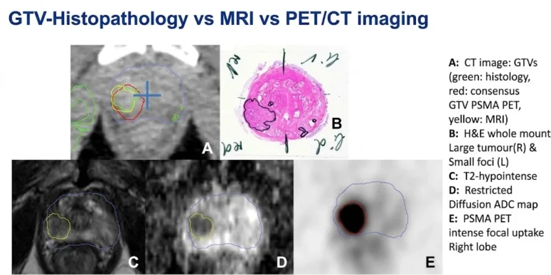 Ramji Rajendran: MRI and PSMA-PET/CT Reveal Different Boundaries of Prostate Cancer